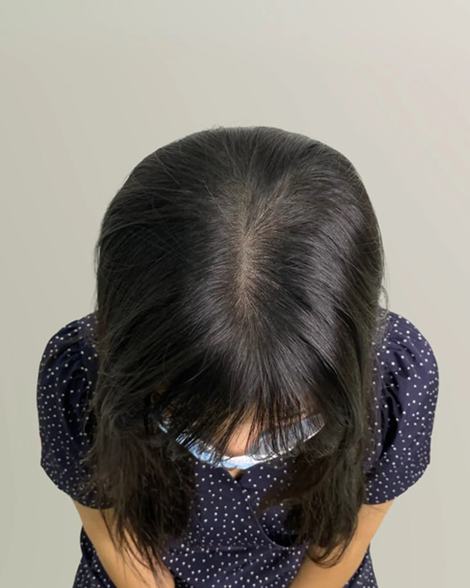 두피문신 시술 전후 사진 5