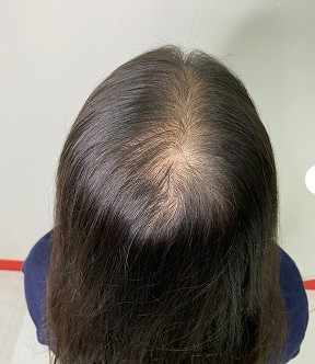 여성 가르마 — 시술 전