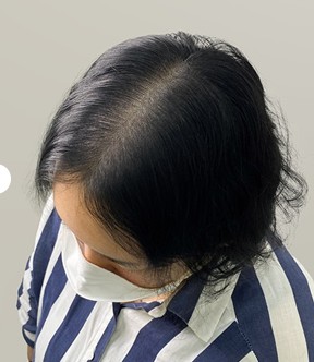 가르마 — 시술 후