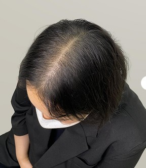 가르마 — 시술 전