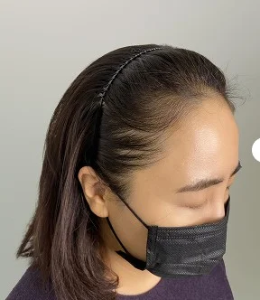가르마 SMP 시술 전 - 가르마 라인 밀도 보강