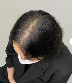 가르마 SMP 시술 전 - 분리선 주변 음영 보정