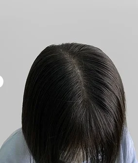 정수리 SMP 시술 후 - 가마 주변 밀도 보강