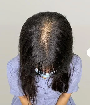 정수리 SMP 시술 전 - 정수리 노출 부위 음영 보정