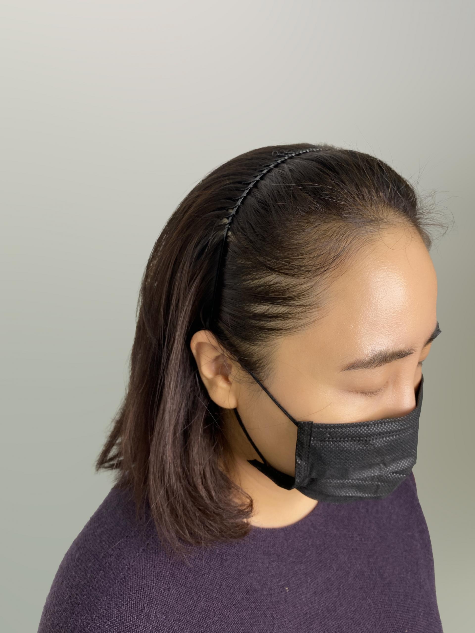 헤어라인 — 시술 전