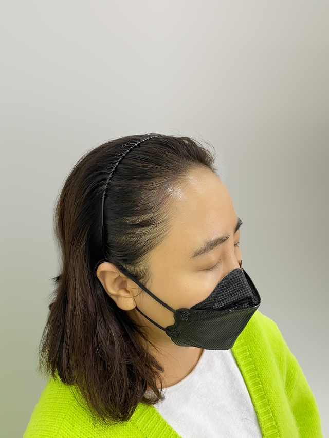 헤어라인 — 시술 후