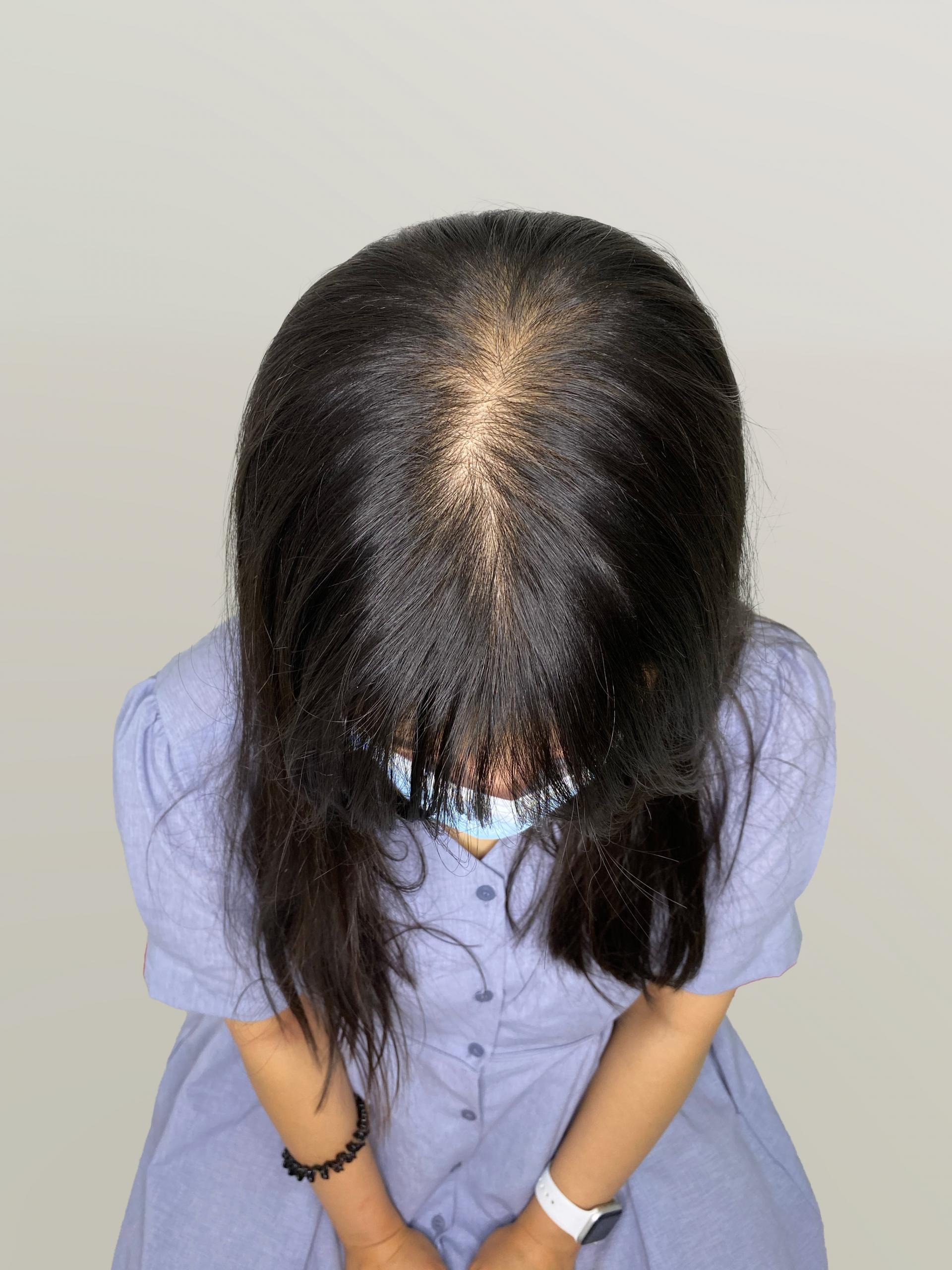 가르마 밀도보강 — 시술 전