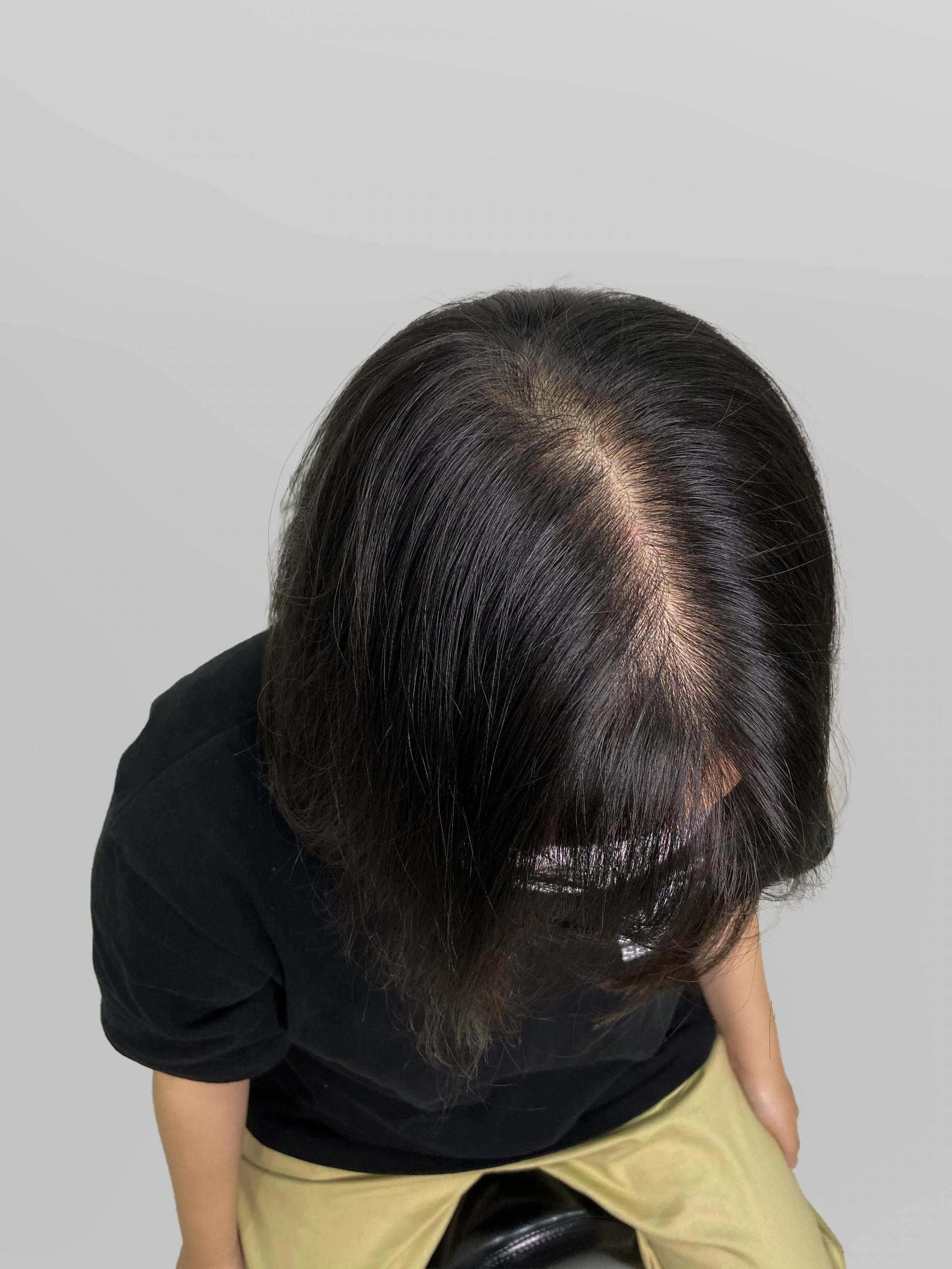 가르마 밀도보강 — 시술 전