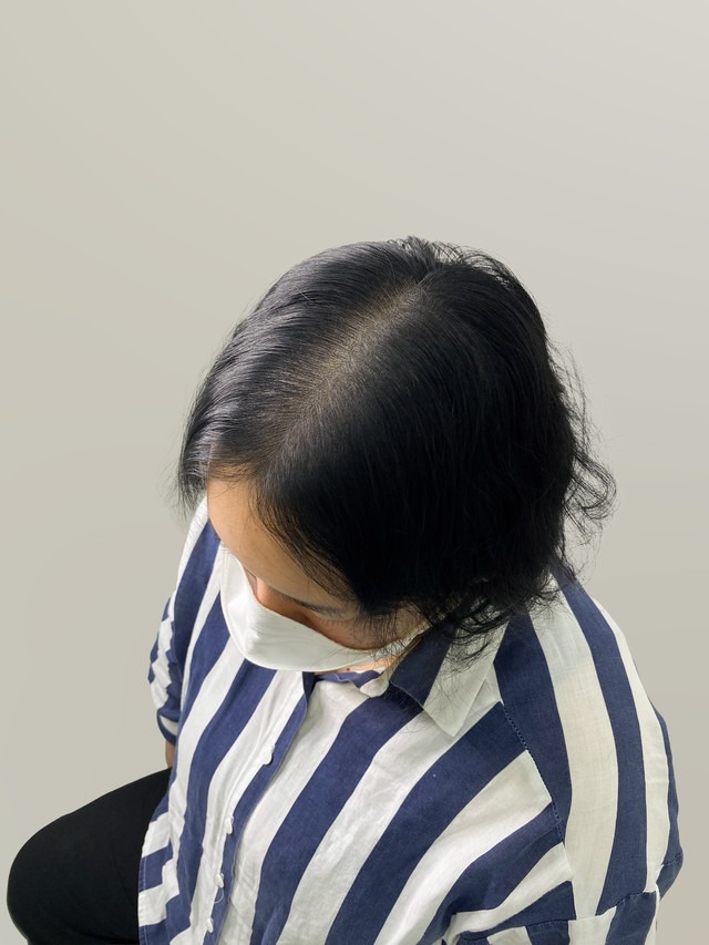 가르마 밀도보강 — 시술 후
