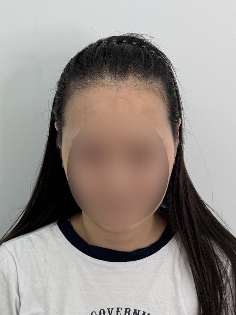 헤어라인 — 시술 전