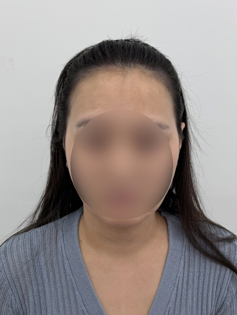 헤어라인 — 시술 후