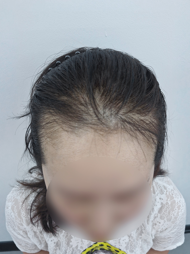 헤어라인 — 시술 전