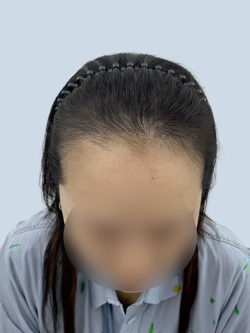 헤어라인 — 시술 후