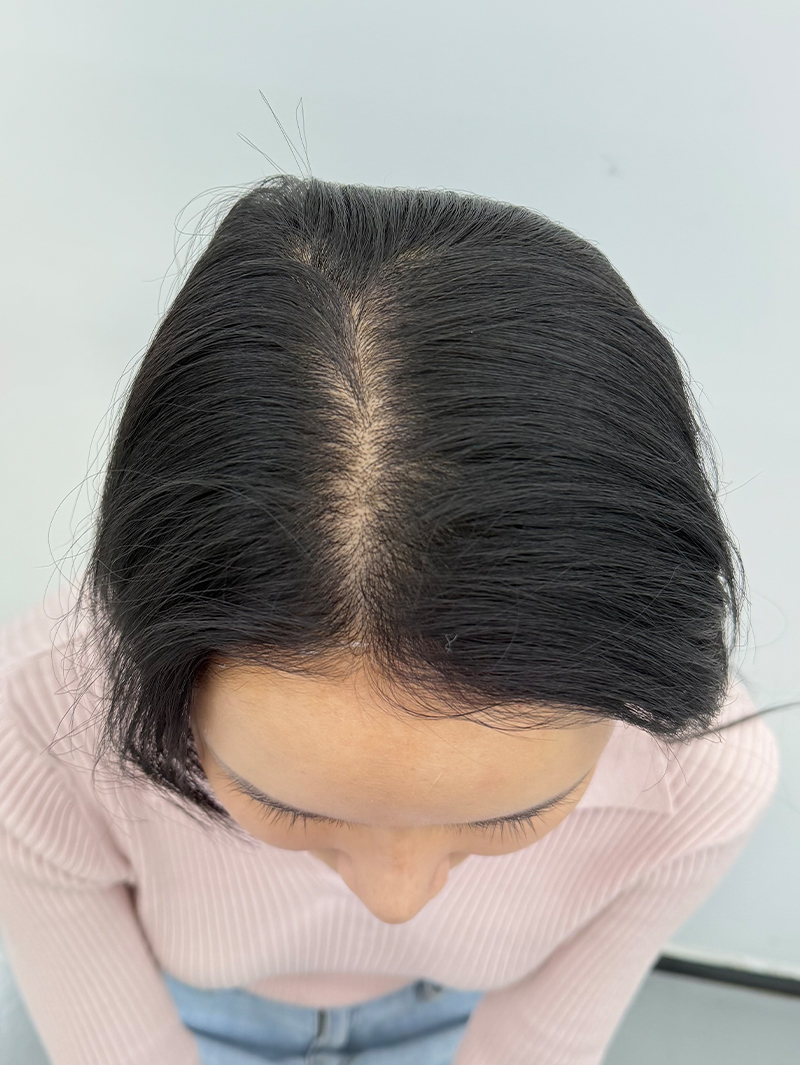 가르마 밀도보강 — 시술 전