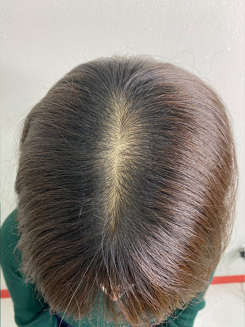 가르마 SMP 시술 전 - 스칼프강의 진피층 모근 정밀 타격(D.R.P : Dermal Root Precision)공법으로 부작용 없이 자연스러운 도트 커버로 가르마 밀도보강을 한 케이스 입니다.