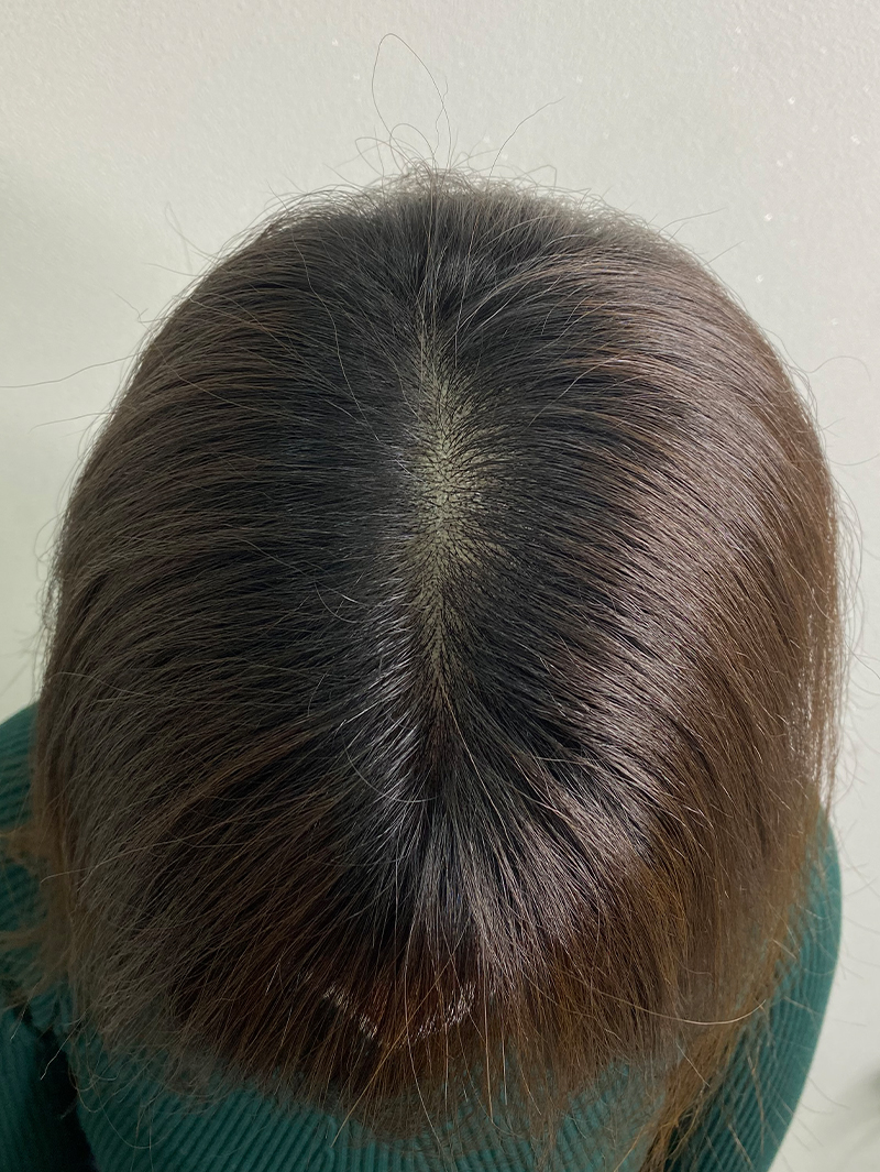 가르마 SMP 시술 후 - 스칼프강의 진피층 모근 정밀 타격(D.R.P : Dermal Root Precision)공법으로 부작용 없이 자연스러운 도트 커버로 가르마 밀도보강을 한 케이스 입니다.