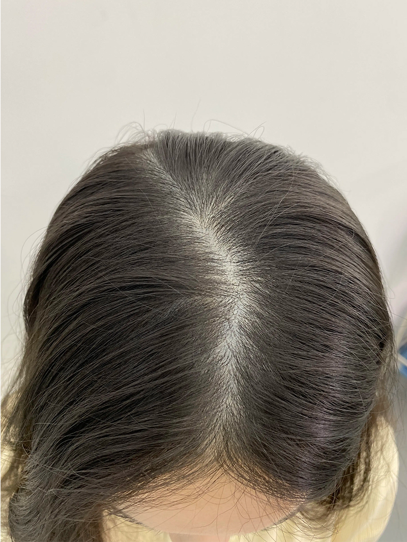 가르마 SMP 시술 전 - 스칼프강의 진피층 모근 정밀 타격(D.R.P : Dermal Root Precision)공법으로 부작용 없이 자연스러운 도트 커버로 가르마 밀도보강을 한 케이스 입니다.
