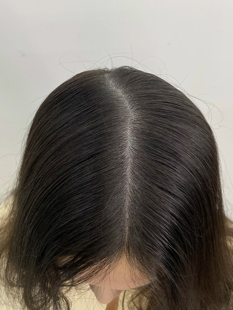 가르마 SMP 시술 후 - 스칼프강의 진피층 모근 정밀 타격(D.R.P : Dermal Root Precision)공법으로 부작용 없이 자연스러운 도트 커버로 가르마 밀도보강을 한 케이스 입니다.
