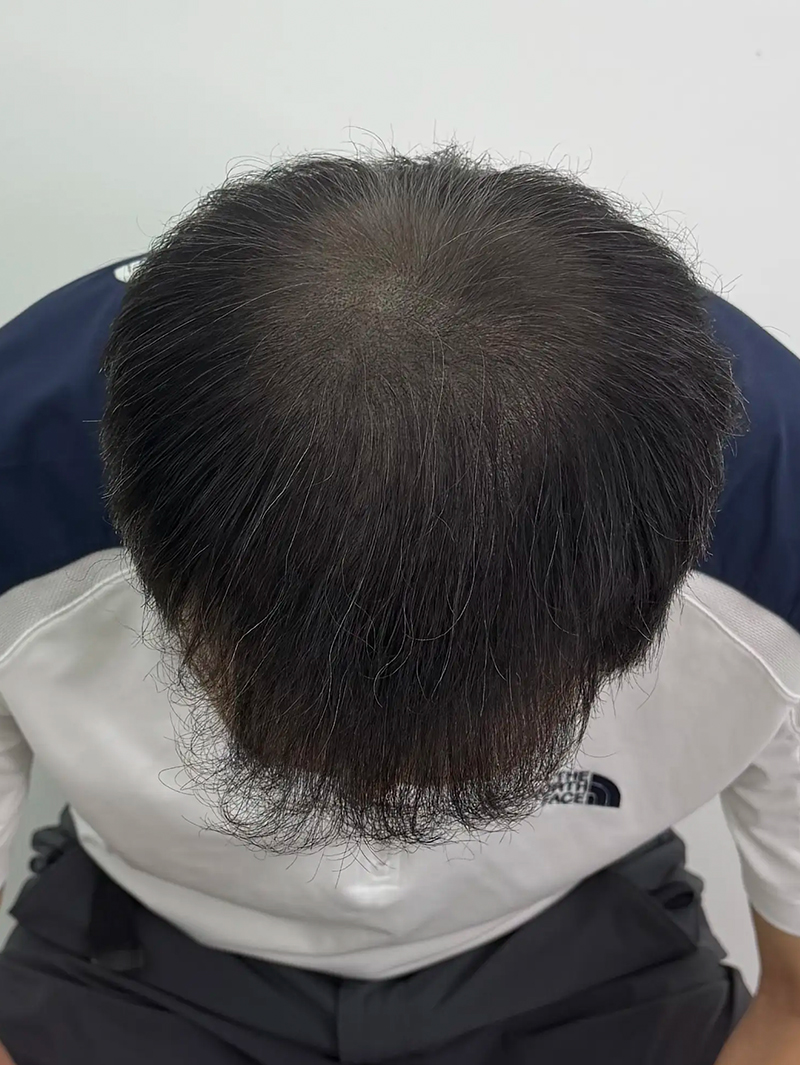 정수리 SMP 시술 후 - 스칼프강의 진피층 모근 정밀 타격(D.R.P : Dermal Root Precision)공법으로 부작용 없이 자연스러운 도트 커버로 남성 정수리 밀도보강을 한 케이스 입니다.
