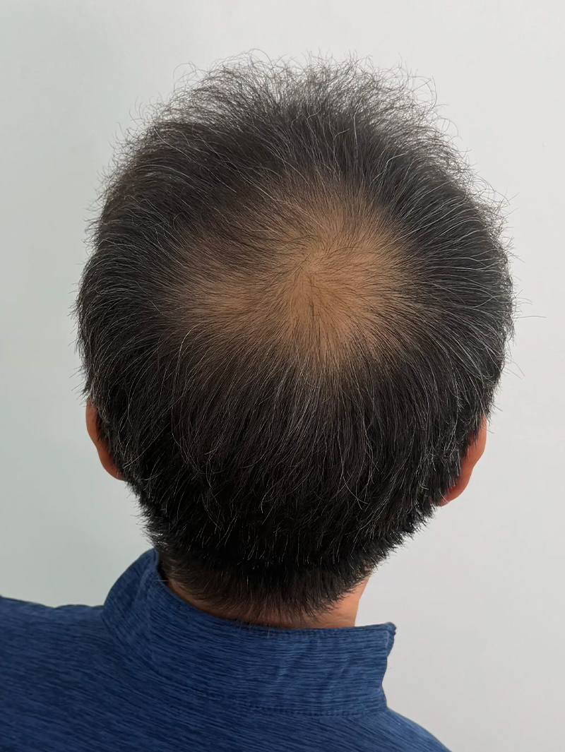 정수리 SMP 시술 전 - 스칼프강의 진피층 모근 정밀 타격(D.R.P : Dermal Root Precision)공법으로 부작용 없이 자연스러운 도트 커버로 남성 정수리 밀도보강을 한 케이스 입니다.