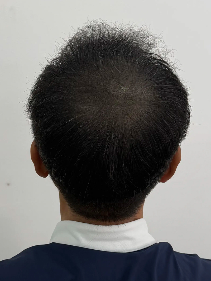 정수리 SMP 시술 후 - 스칼프강의 진피층 모근 정밀 타격(D.R.P : Dermal Root Precision)공법으로 부작용 없이 자연스러운 도트 커버로 남성 정수리 밀도보강을 한 케이스 입니다.