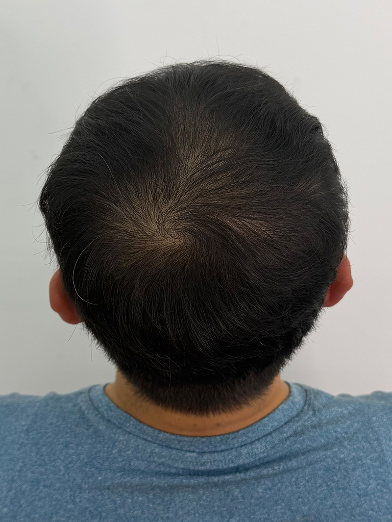정수리 SMP 시술 전 - 스칼프강의 진피층 모근 정밀 타격(D.R.P : Dermal Root Precision)공법으로 부작용 없이 자연스러운 도트 커버로 남성 정수리 밀도보강을 한 케이스 입니다.