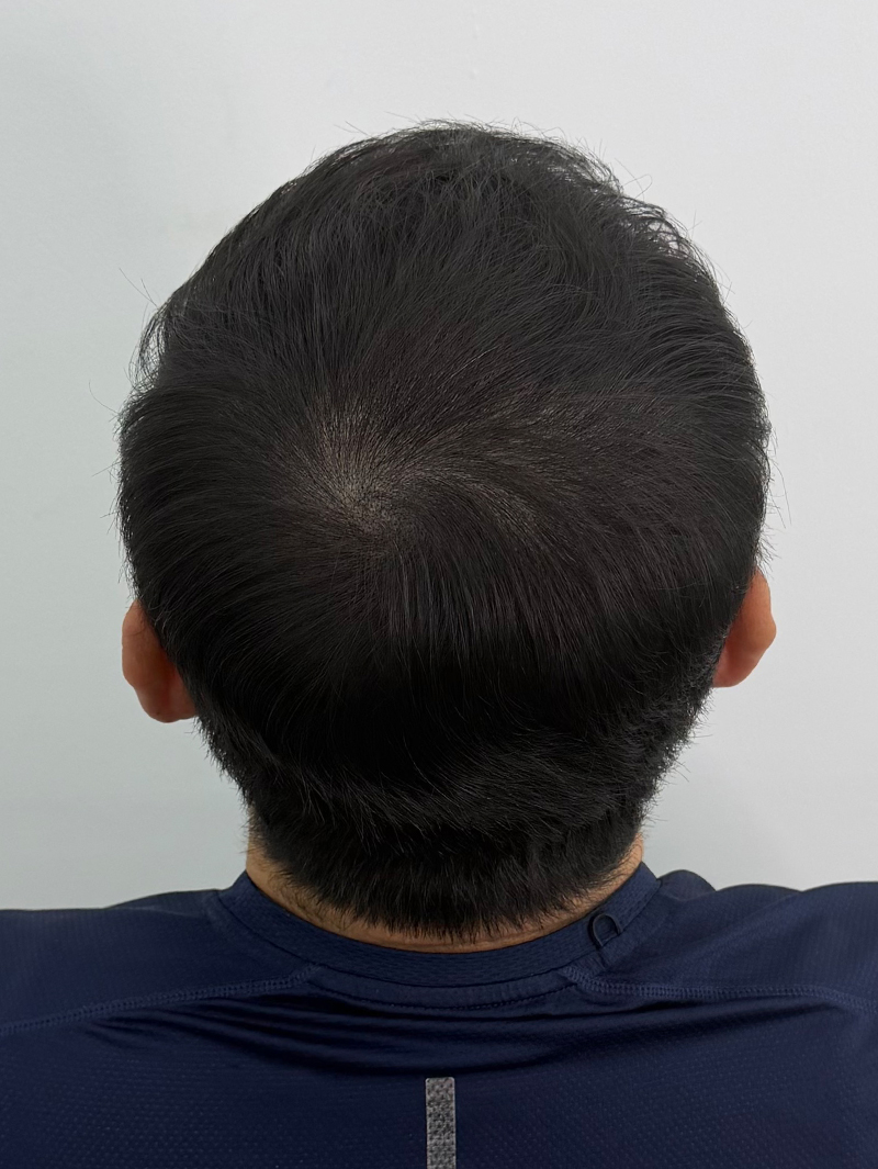 정수리 SMP 시술 후 - 스칼프강의 진피층 모근 정밀 타격(D.R.P : Dermal Root Precision)공법으로 부작용 없이 자연스러운 도트 커버로 남성 정수리 밀도보강을 한 케이스 입니다.