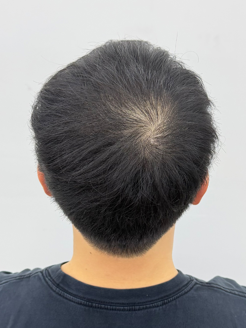 정수리 SMP 시술 전 - 스칼프강의 진피층 모근 정밀 타격(D.R.P : Dermal Root Precision)공법으로 부작용 없이 자연스러운 도트 커버로 남성 정수리 밀도보강을 한 케이스 입니다.