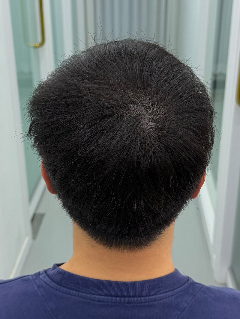 정수리 SMP 시술 후 - 스칼프강의 진피층 모근 정밀 타격(D.R.P : Dermal Root Precision)공법으로 부작용 없이 자연스러운 도트 커버로 남성 정수리 밀도보강을 한 케이스 입니다.
