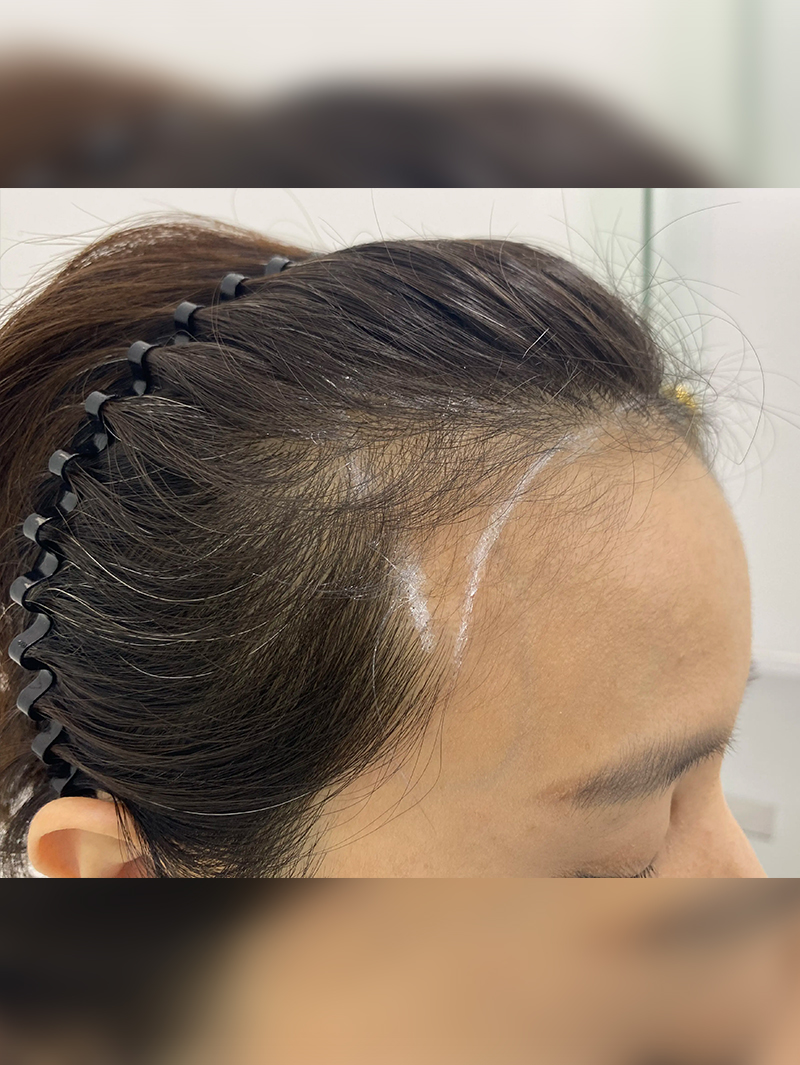 헤어라인 — 시술 전