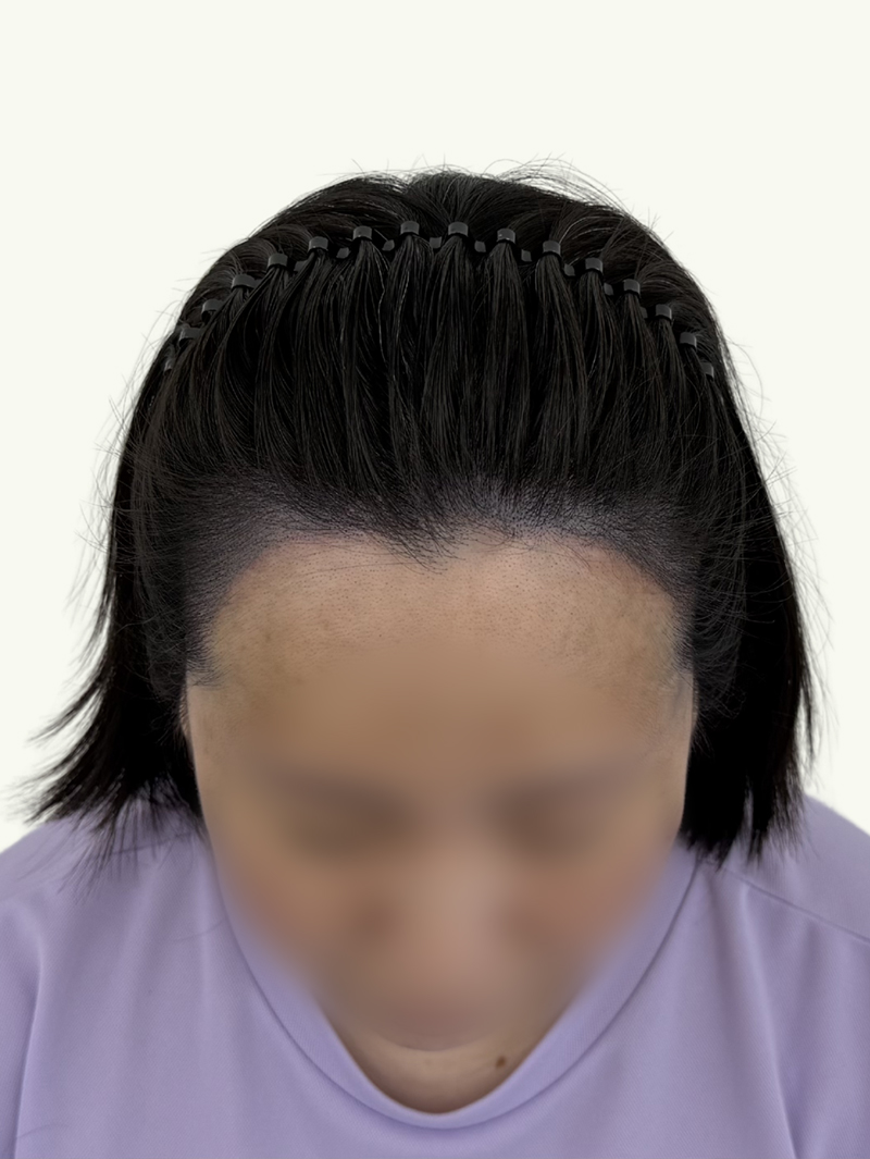 헤어라인 SMP 시술 후 - 스칼프강의 진피층 모근 정밀 타격(D.R.P : Dermal Root Precision)공법으로 부작용 없이 자연스러운 도트 커버로 헤어라인 복구 시술을 한 케이스 입니다.
