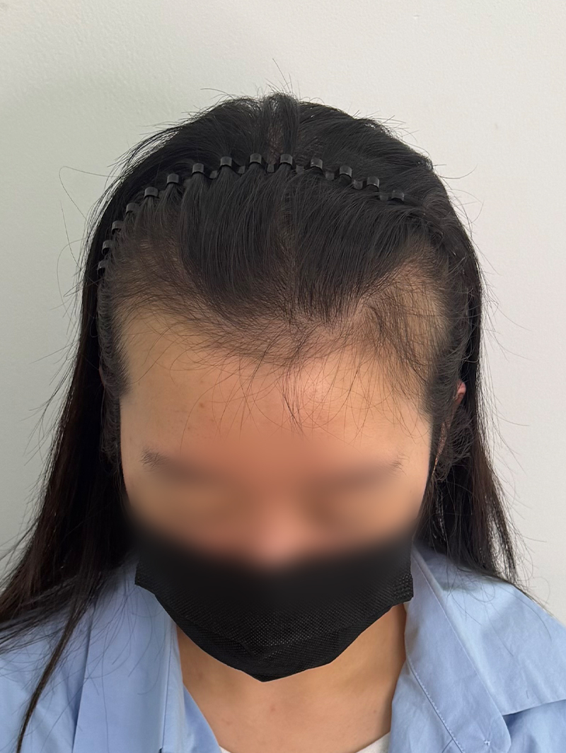 헤어라인 SMP 시술 전 - 스칼프강의 진피층 모근 정밀 타격(D.R.P : Dermal Root Precision)공법으로 부작용 없이 자연스러운 도트 커버로 헤어라인을 잡은 케이스 입니다.