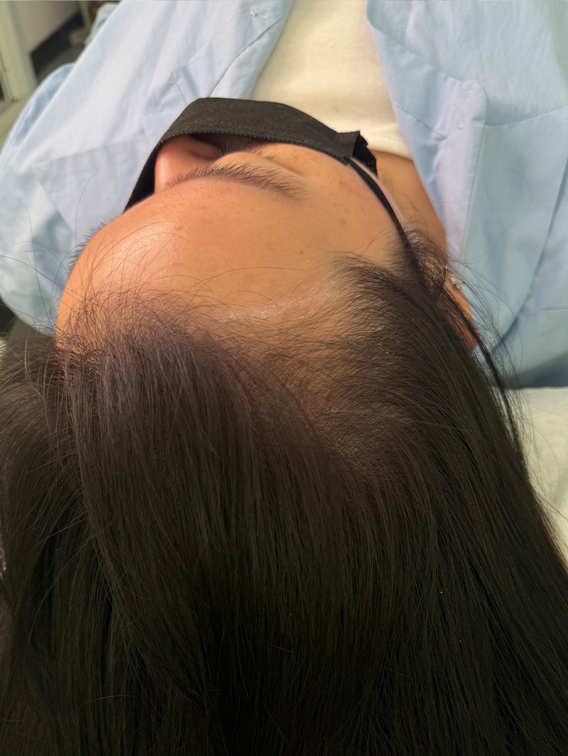 헤어라인 SMP 시술 전 - 스칼프강의 진피층 모근 정밀 타격(D.R.P : Dermal Root Precision)공법으로 부작용 없이 자연스러운 도트 커버로 헤어라인을 잡은 케이스 입니다.