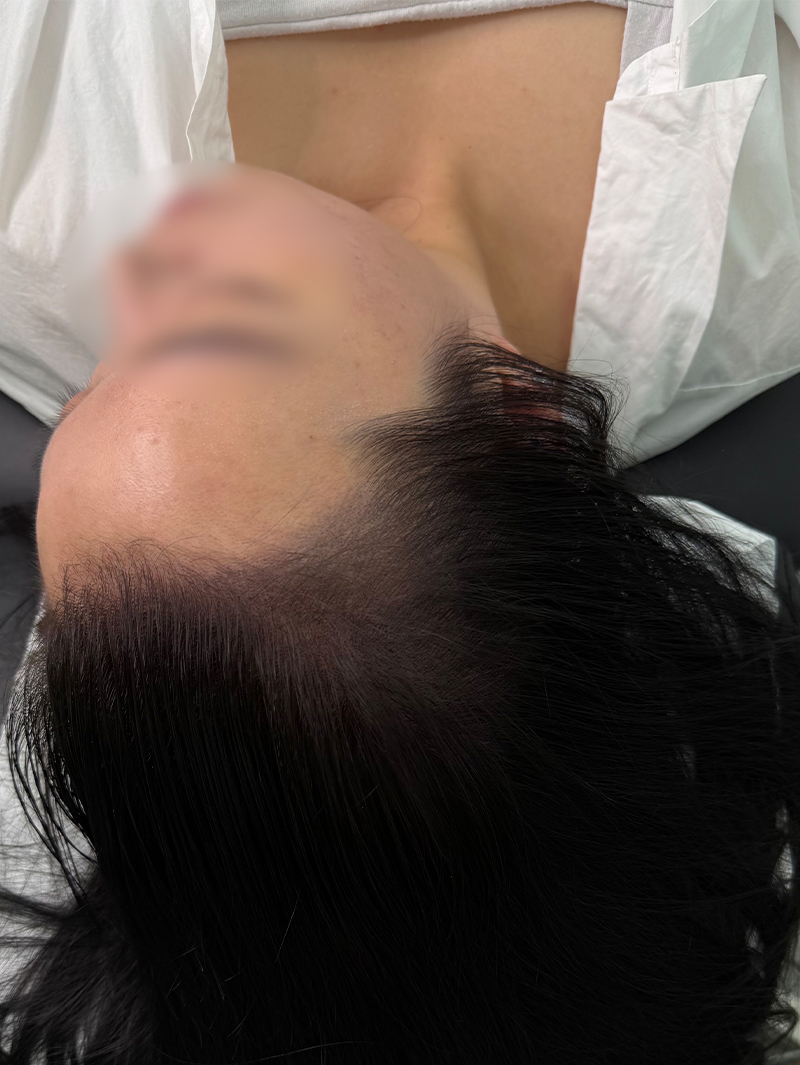 헤어라인 SMP 시술 후 - 스칼프강의 진피층 모근 정밀 타격(D.R.P : Dermal Root Precision)공법으로 부작용 없이 자연스러운 도트 커버로 헤어라인을 잡은 케이스 입니다.