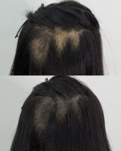 발모벽(발모광)이란? 탈모 원인과 원형탈모 차이, SMP까지 알아보기