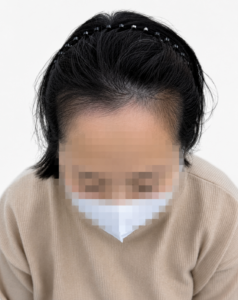헤어라인 SMP는 디자인이 90%입니다｜실패와 복구 사례로 알아보는 자연스러운 헤어라인