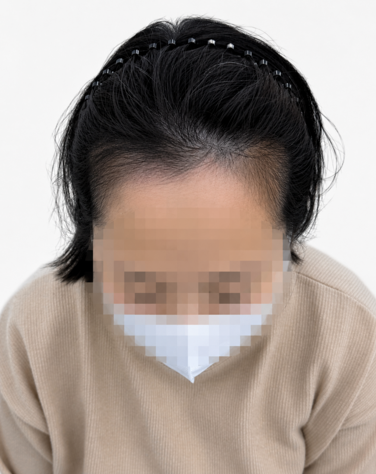 헤어라인 SMP는 디자인이 90%입니다｜실패와 복구 사례로 알아보는 자연스러운 헤어라인