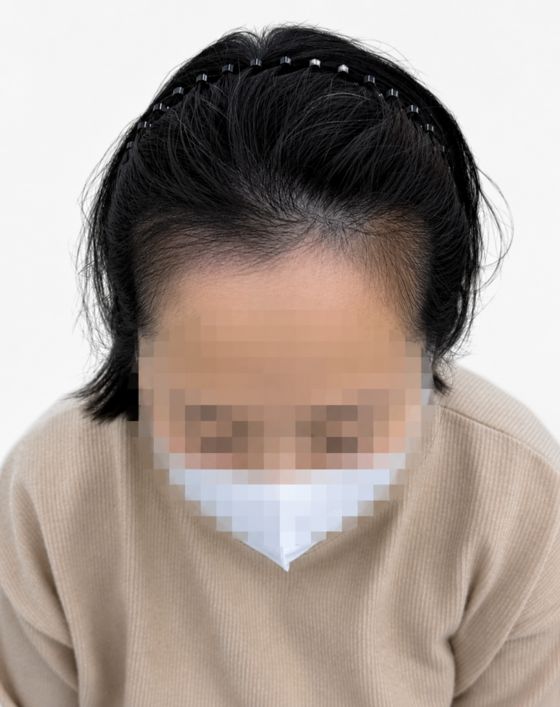 헤어라인 SMP는 디자인이 90%입니다｜실패와 복구 사례로 알아보는 자연스러운 헤어라인 대표 썸네일