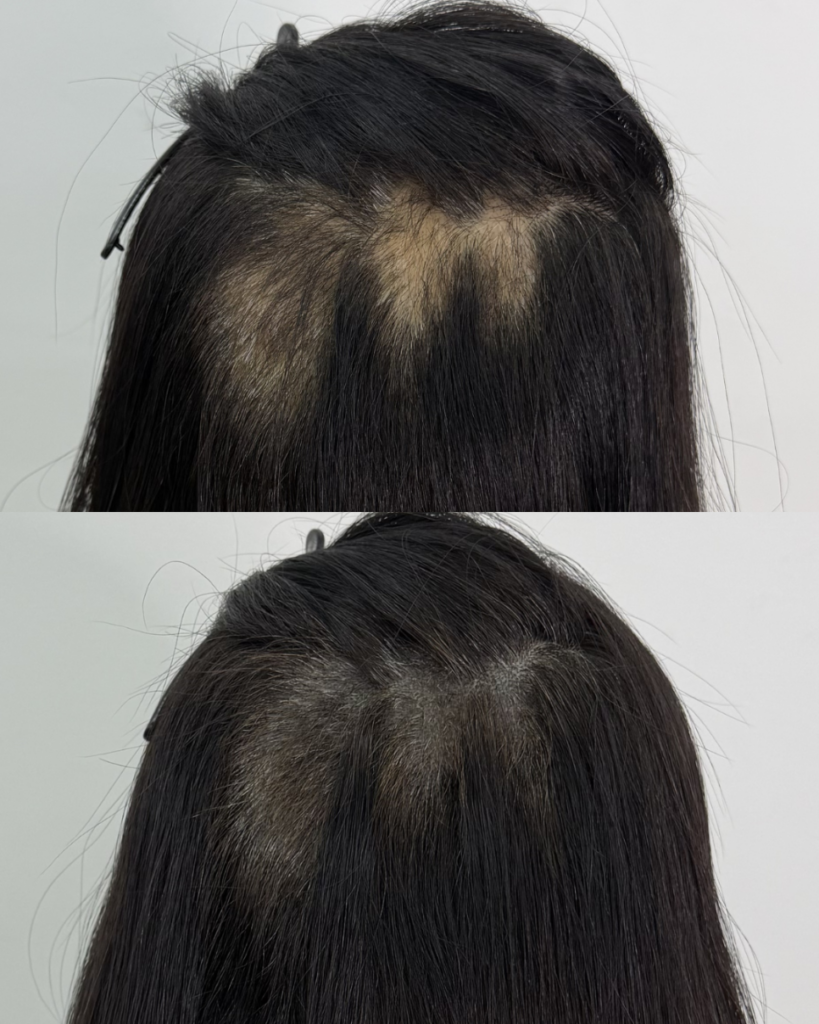 탈모의 원인 중 하나, 발모벽(Trichotillomania)이란?