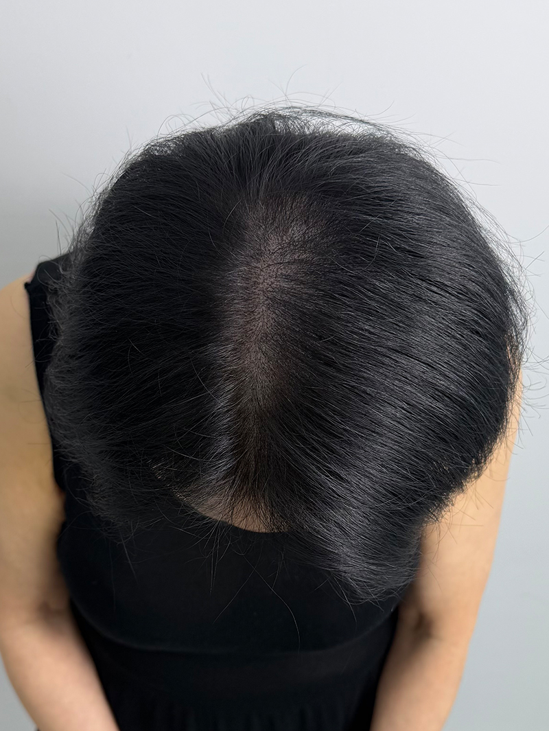 가르마 SMP 시술 후 - 스칼프강의 진피층 모근 정밀 타격(D.R.P : Dermal Root Precision)공법으로 부작용 없이 자연스러운 도트 커버로 가르마 밀도보강을 한 케이스 입니다.