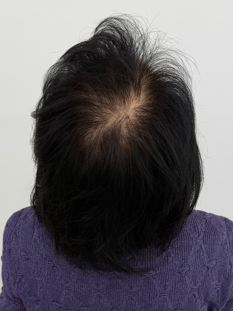 가르마 SMP 시술 전 - 스칼프강의 진피층 모근 정밀 타격(D.R.P : Dermal Root Precision)공법으로 부작용 없이 자연스러운 도트 커버로 가르마 밀도보강을 한 케이스 입니다.