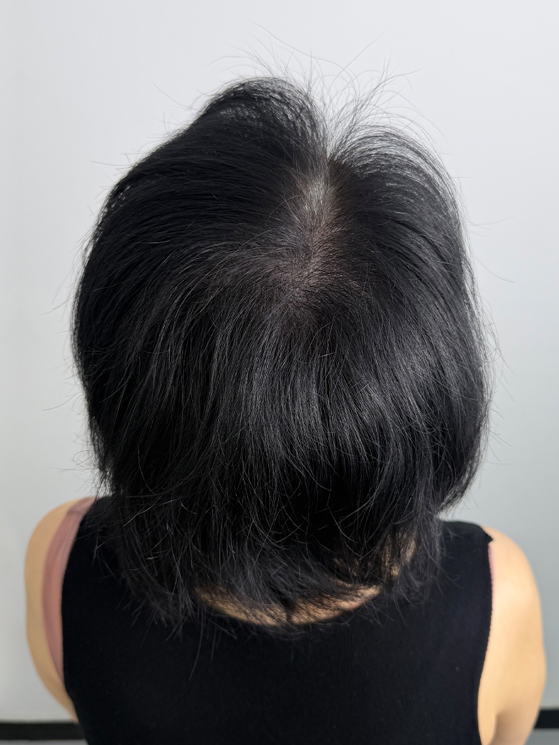 가르마 SMP 시술 후 - 스칼프강의 진피층 모근 정밀 타격(D.R.P : Dermal Root Precision)공법으로 부작용 없이 자연스러운 도트 커버로 가르마 밀도보강을 한 케이스 입니다.