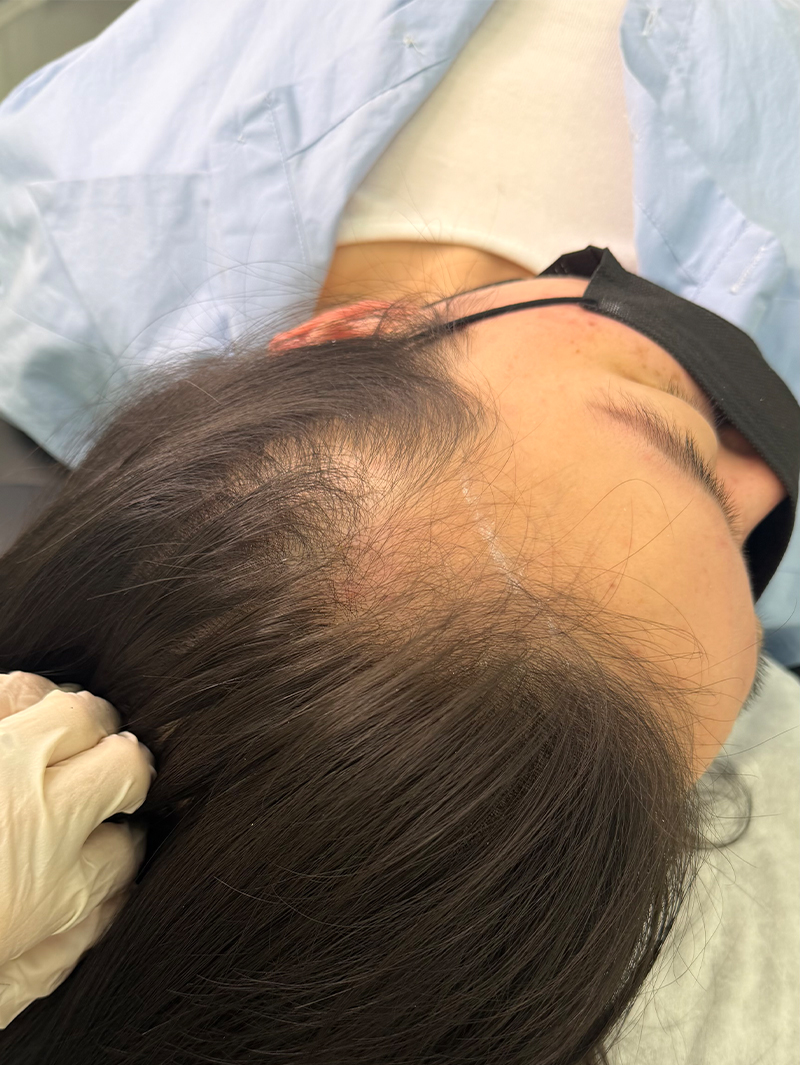 헤어라인 SMP 시술 전 - 스칼프강의 진피층 모근 정밀 타격(D.R.P : Dermal Root Precision)공법으로 부작용 없이 자연스러운 도트 커버로 헤어라인을 잡은 케이스 입니다.