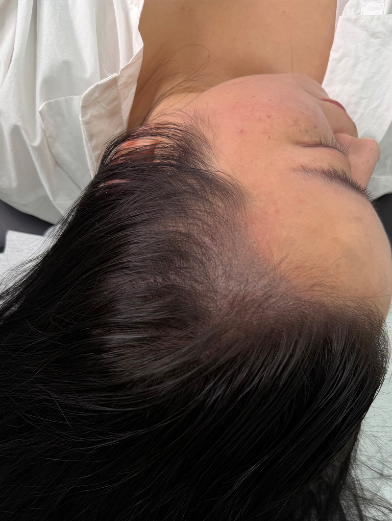 헤어라인 SMP 시술 후 - 스칼프강의 진피층 모근 정밀 타격(D.R.P : Dermal Root Precision)공법으로 부작용 없이 자연스러운 도트 커버로 헤어라인을 잡은 케이스 입니다.