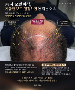 M자 모발이식 했는데 가운데가 비었다? 모발이식 후 SMP 실제 사례