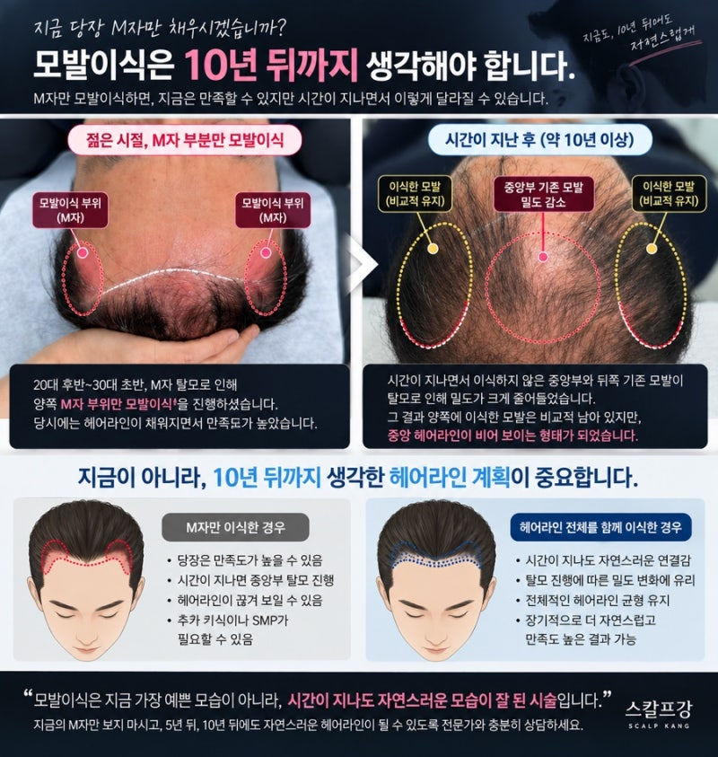 20대 30대 M자 모발이식과 모발이식 후 SMP 장기 계획