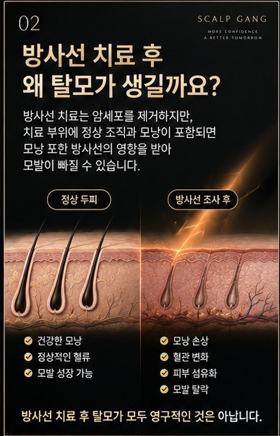 방사선 치료 후 탈모가 모두 영구적인건 아닙니다. 스칼프강