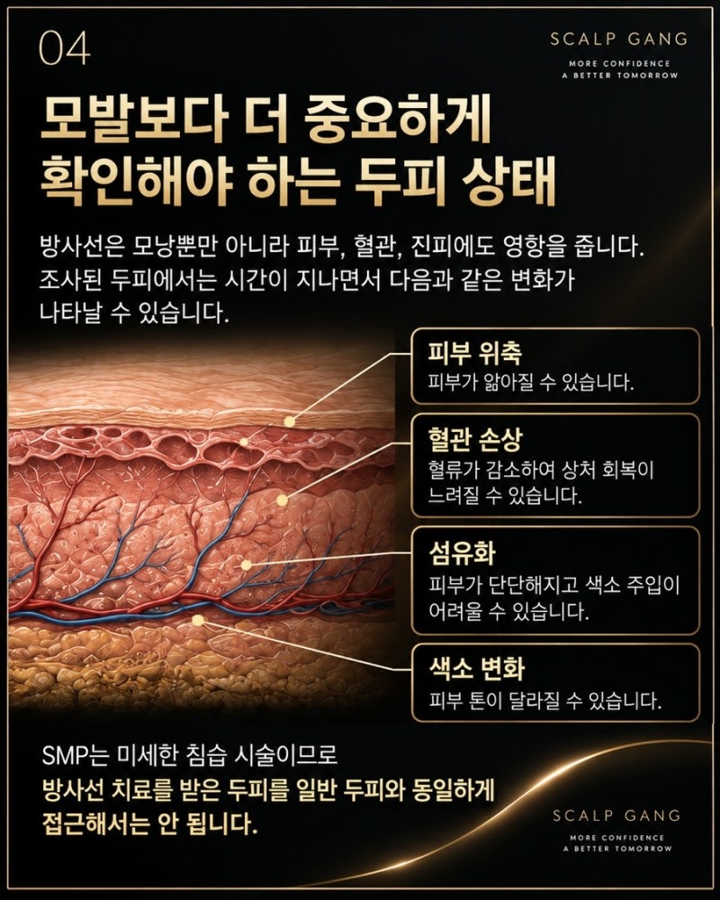 스칼프강에서는 방사선 치료를 받은 두피를 일반 두피와 동일하게 접근하지 않습니다. 