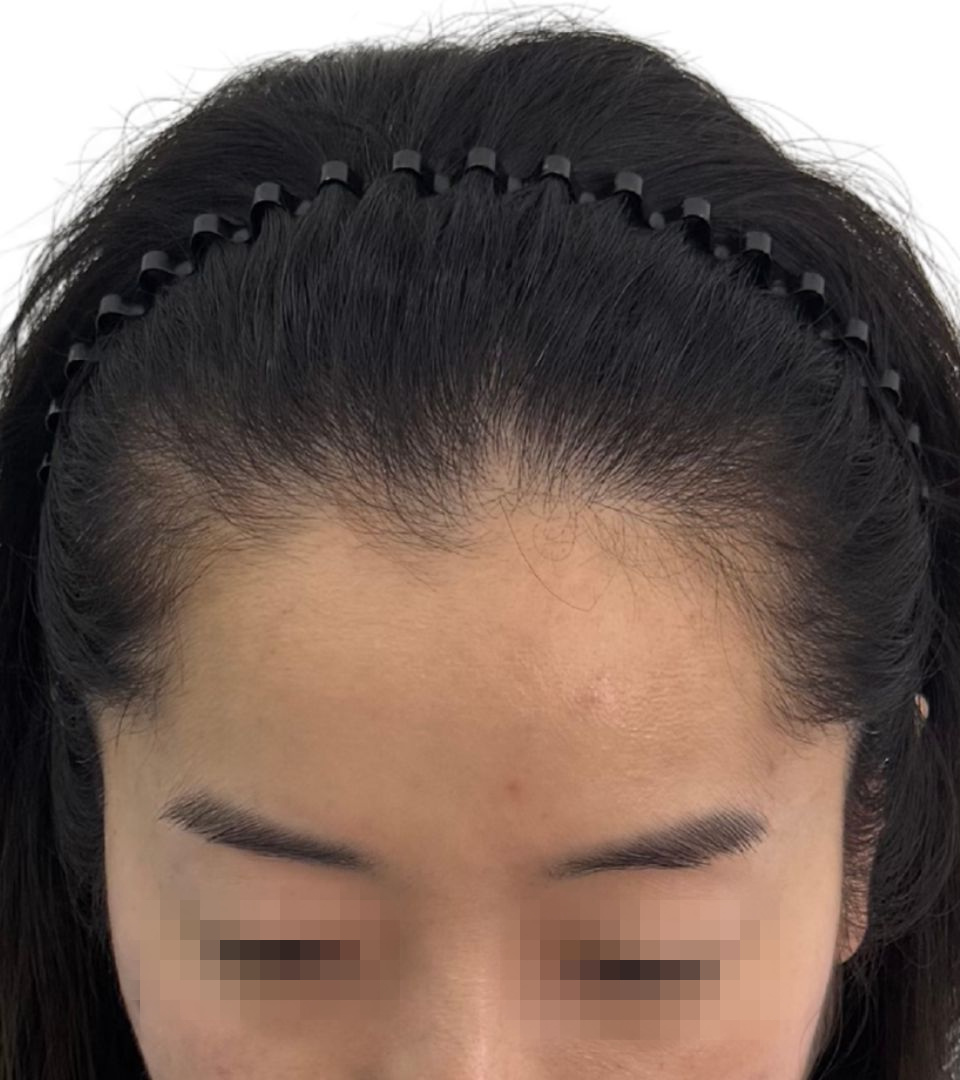 헤어라인 — 시술 전